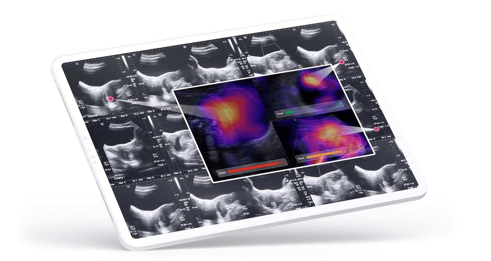 Tablet showing the Preterm AI interface: ultrasound scan sequences with heatmap overlays and colour-coded risk indicators
